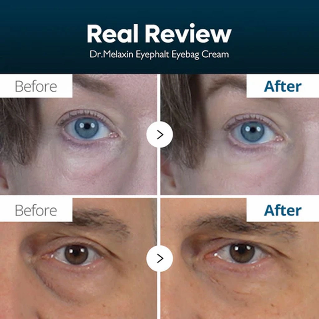 Eyephalt Eyecream for Eyebags