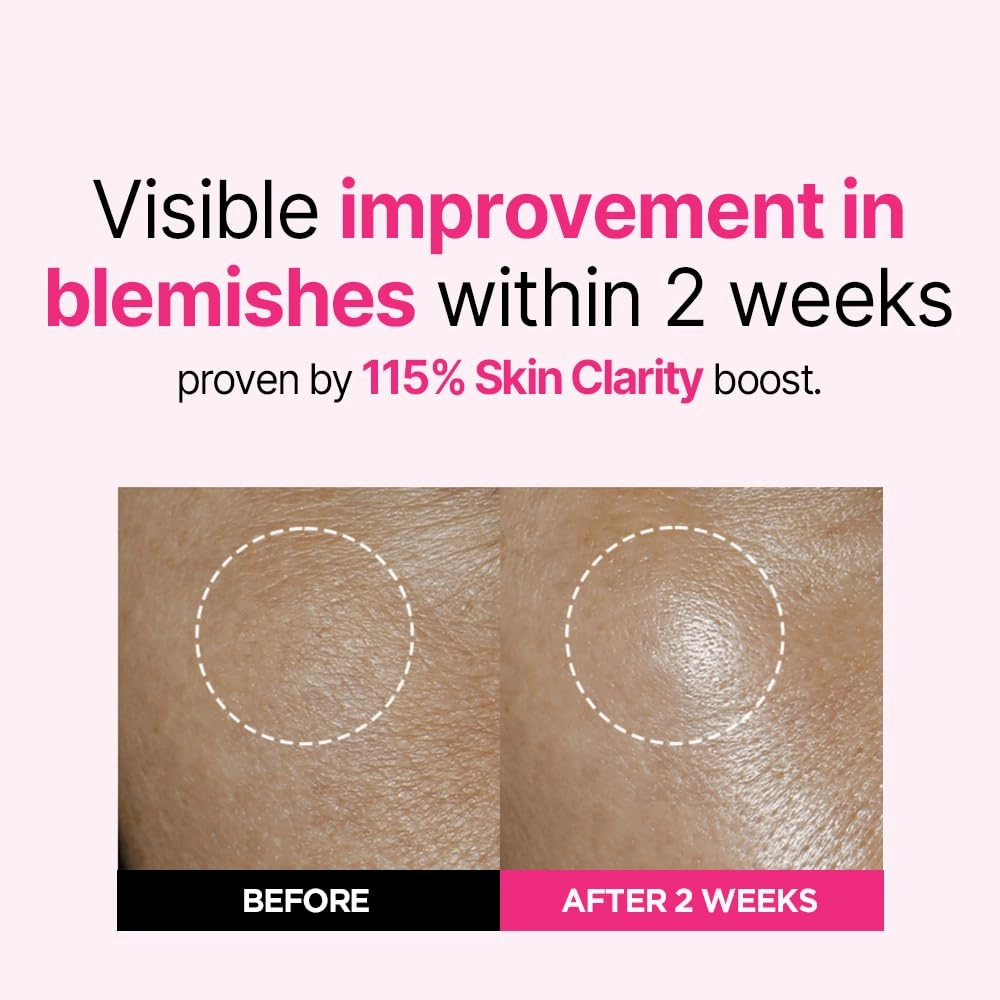 ISOI Blemish Care Up Serum, Vegan Hydrating Serum for Smooth & Glass Skin Effect, Skin Barrier & Moisture Balance, Korean Skin Care (1.18 fl. oz, 35ml)