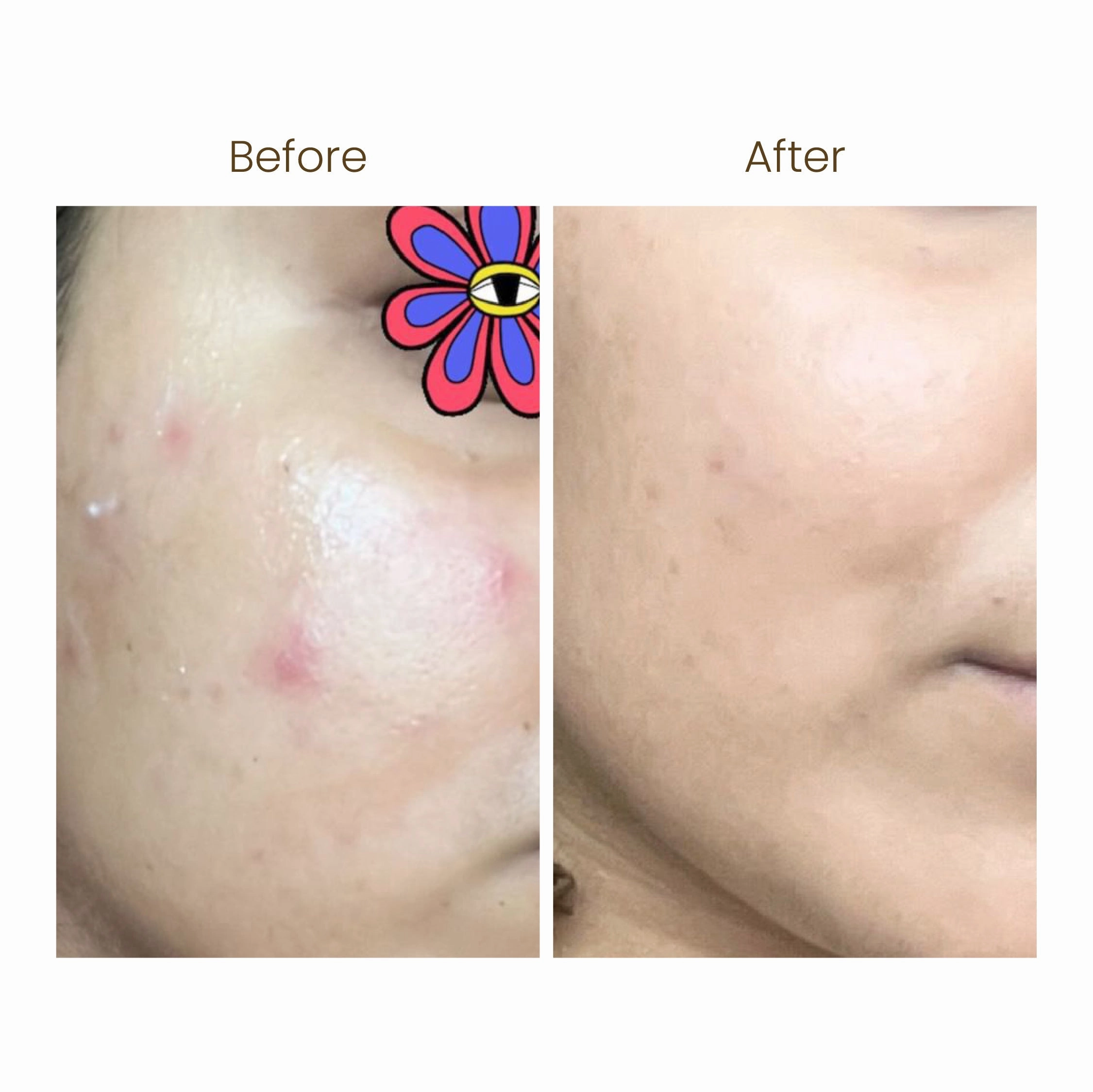 Youthburst Clinically Approved Water Gel Moisturiser 72 Hrs Hydration Hyaluronic Acid - Oily, Normal & Combination Skin